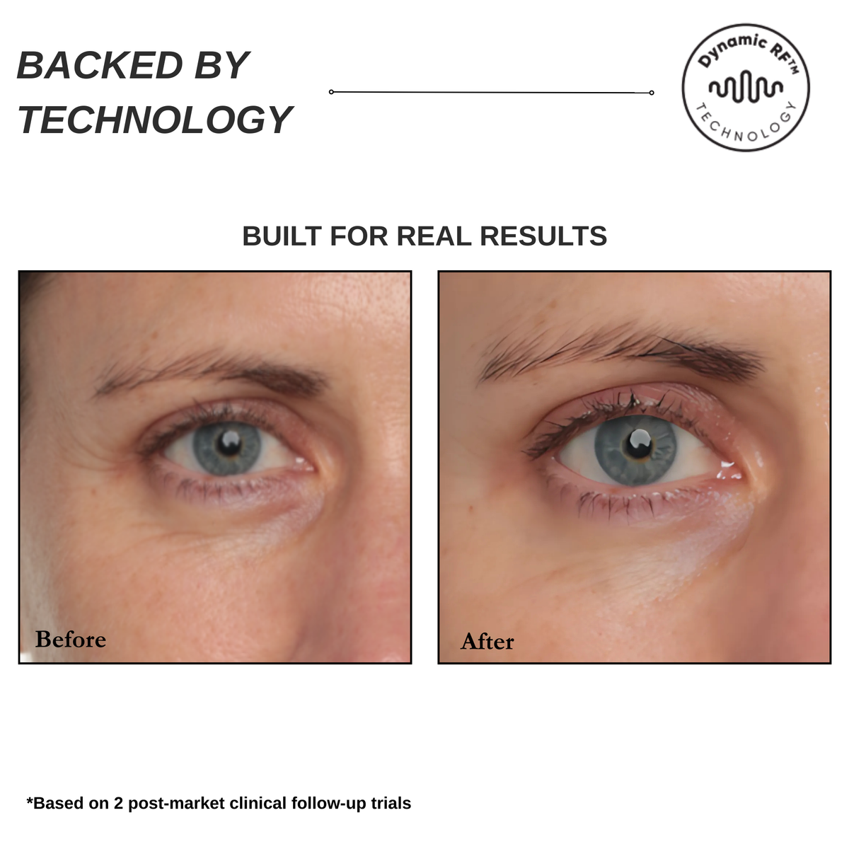 Sensilift Mini Skin Tightening