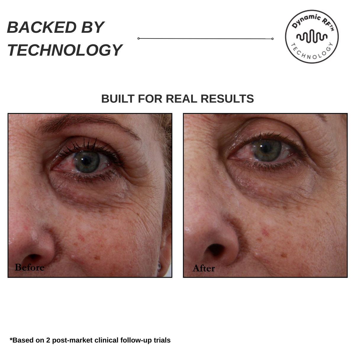 Sensilift At-Home Skin-Firming