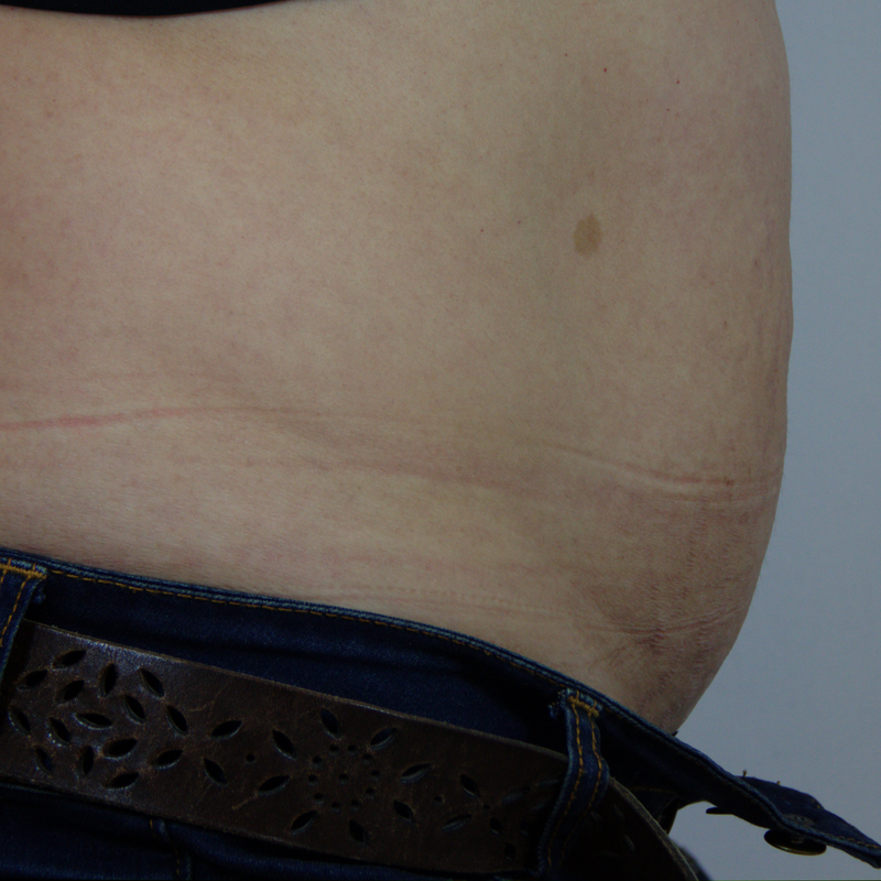 Belly after Sensifirm