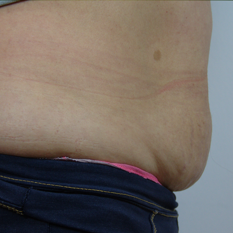 Belly before Sensifirm