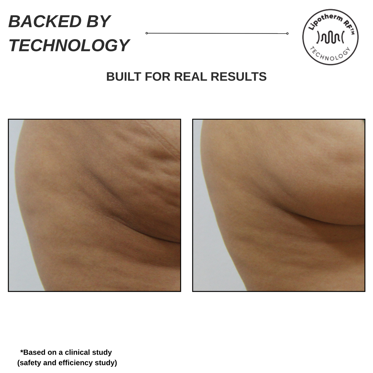 Sensifirm Anti-Cellulite Skin Tightening