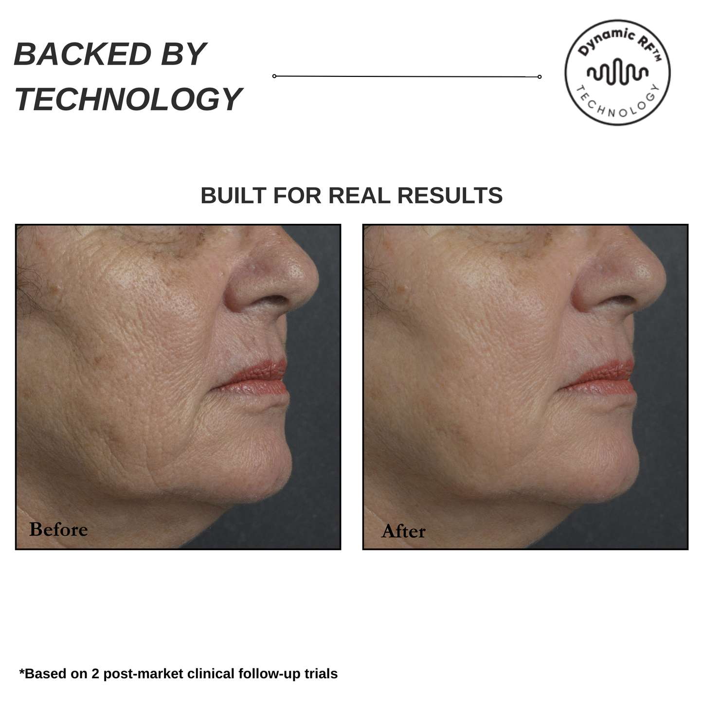 Sensilift Smart RF Skin-Firming