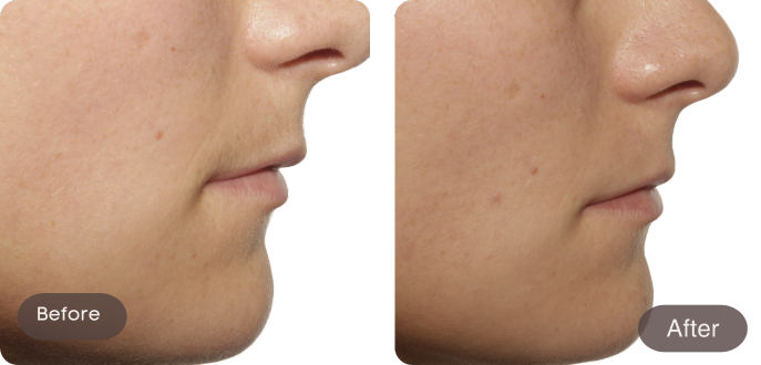 Before and after comparison