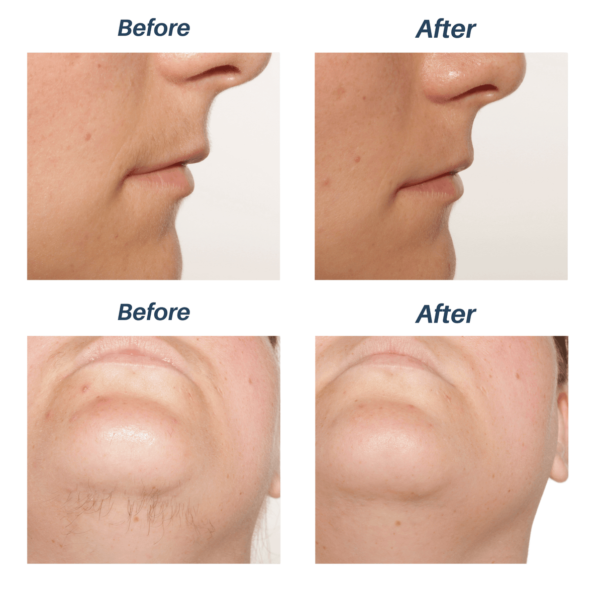 Before and After Facial Hair